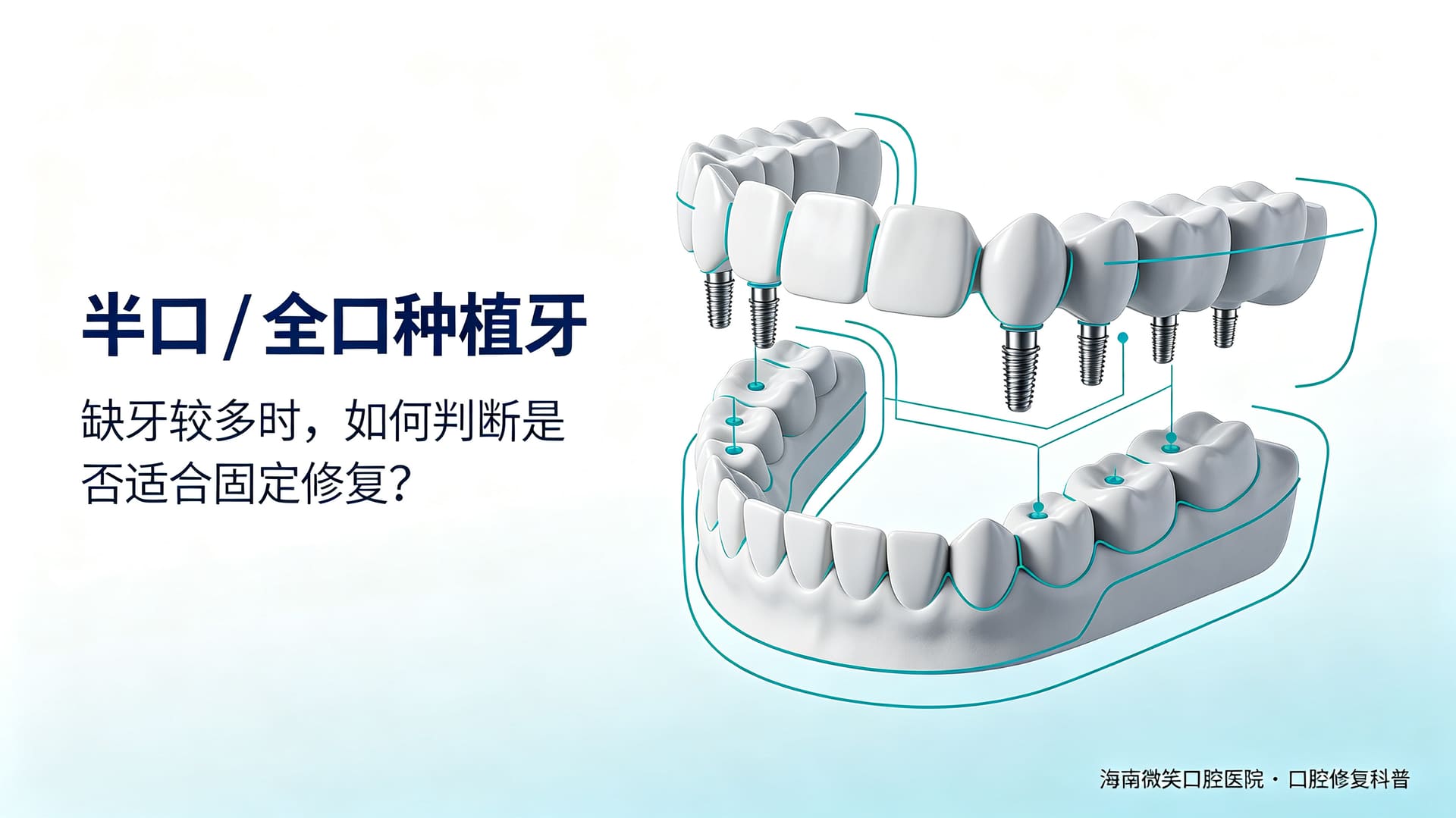 半口全口种植牙是什么?适不适合你?海口怎么看机构靠不靠谱——海南微笑口腔医院